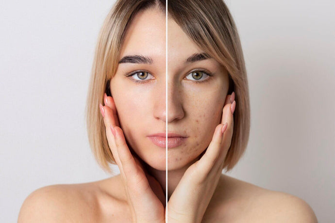How to go from 'skin purge' to radiant skin without dying trying